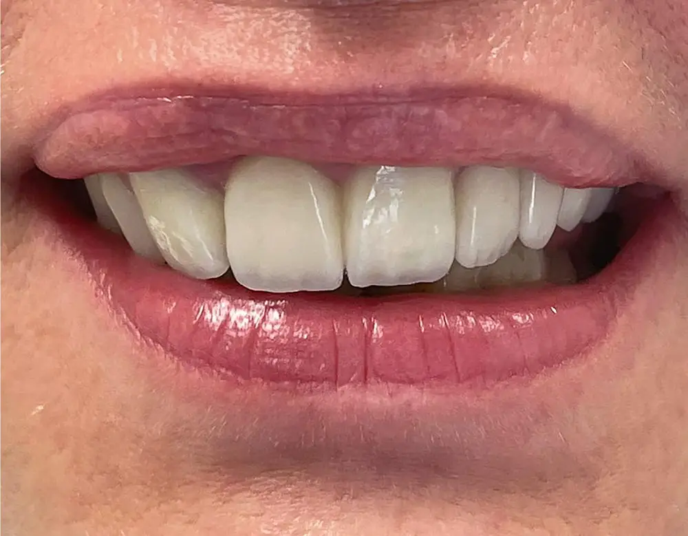 smile-gallery-03-nachher